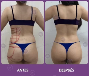Lipotransferencia 3